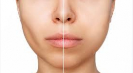 Sagging Face Treatment: Restoring Your Youthful Glow