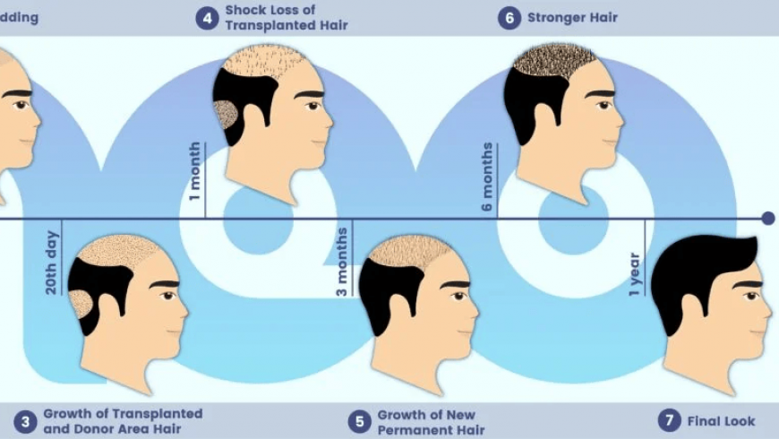 Exploring the Benefits of Hair Replacement in Turkey