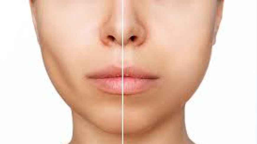 Sagging Face Treatment: Restoring Your Youthful Glow